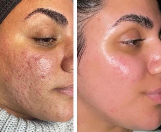 MORPHEUS8 (3 sessions $550 per session ) Clinic Use only