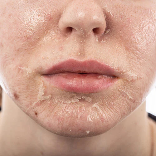 Acne Getaway Facial  ( Microdermabrasion & Chemical Peel)