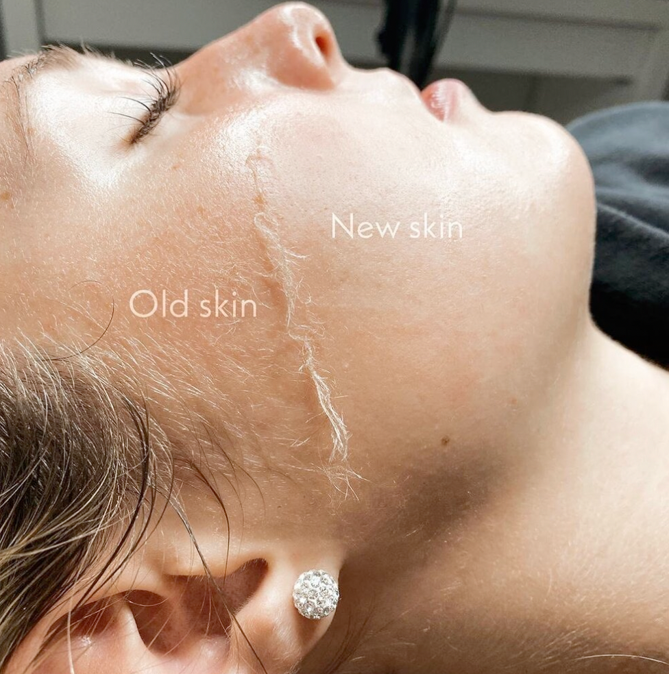 Dew and Renew Facial ( Dermaplaning Facial)