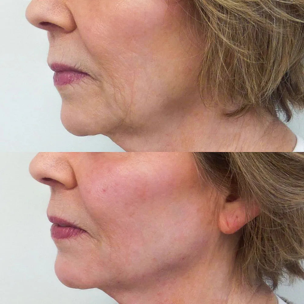 Lower face Marionettes & Jowls 2 syringes package (not shipped, clinic use only)