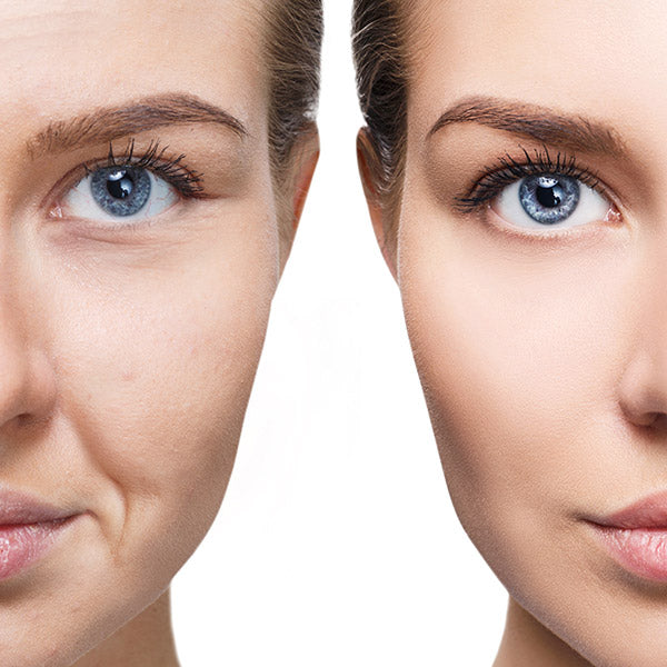 PRF facelift 3 session (clinic use only, not shipped)