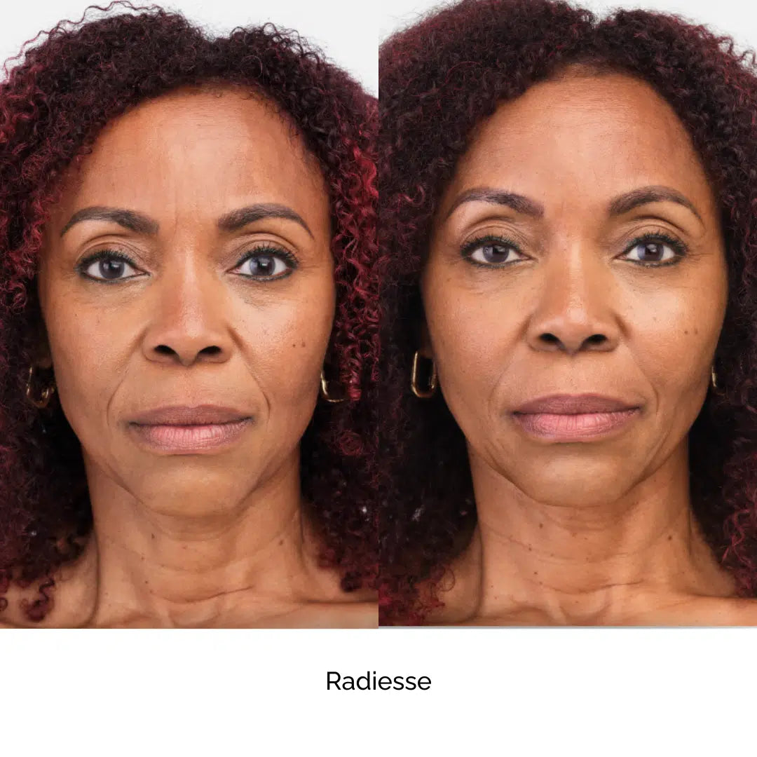 3 Syringes Radiesse Face, Neck or Hand Rejuvenation (not shipped, clinic use only)