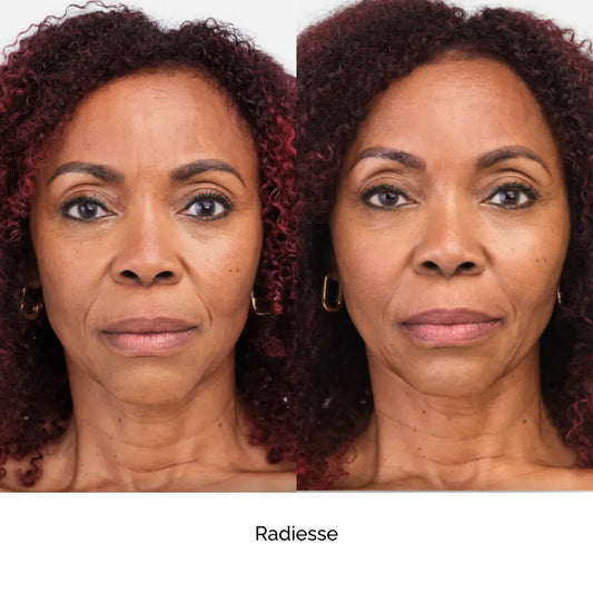 3 Syringes Radiesse Face, Neck or Hand Rejuvenation (not shipped, clinic use only)