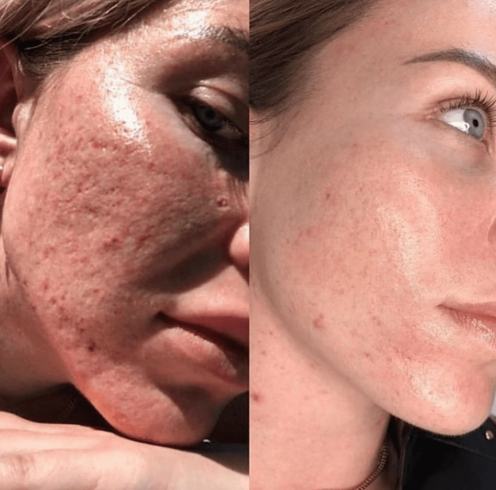 Nano Fractional (skin resurfacing, scars, aging)