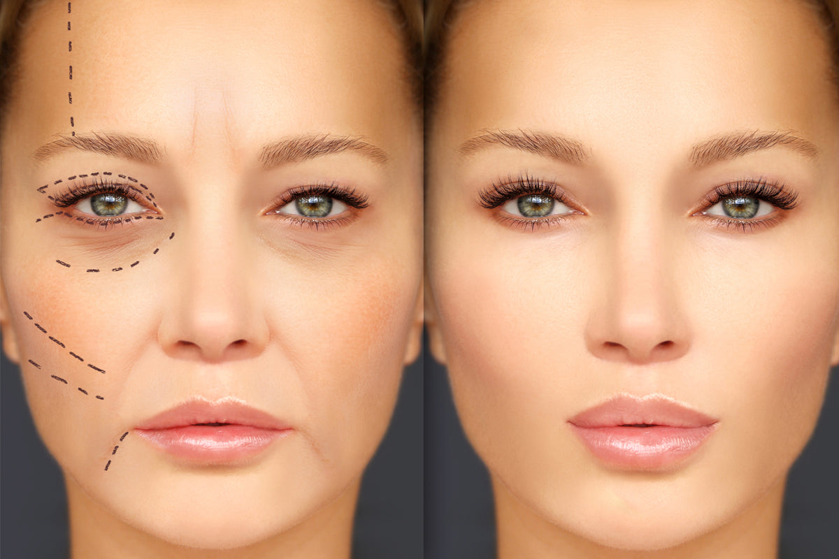 Liquid Facelift  (6 syringes of filler) not to be shipped. Clinic use only