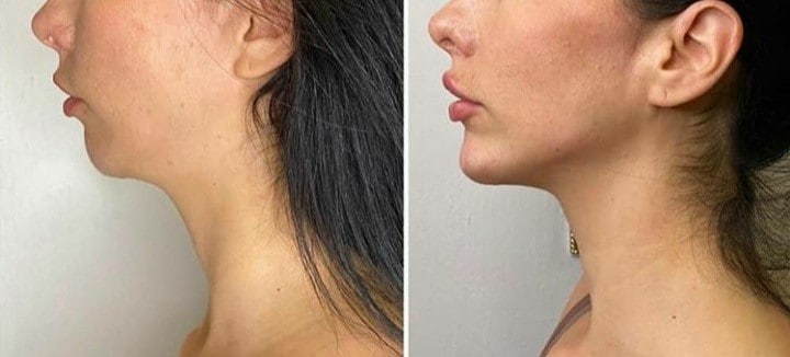 Liquid Facelift  4 Syringes Package (not shipped, clinic use only)