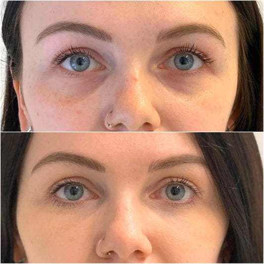 PRF facelift 3 session (clinic use only, not shipped)