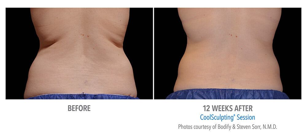 CoolSculpting® Flanks 2 Cycles