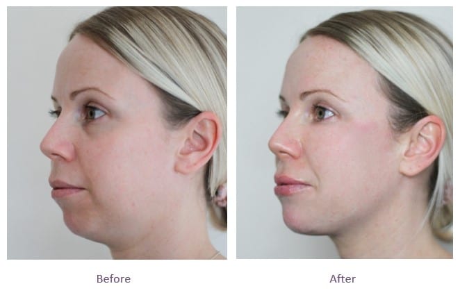 Lower face rejuvenation-  2 syringe package ( not shipped, clinic use only)