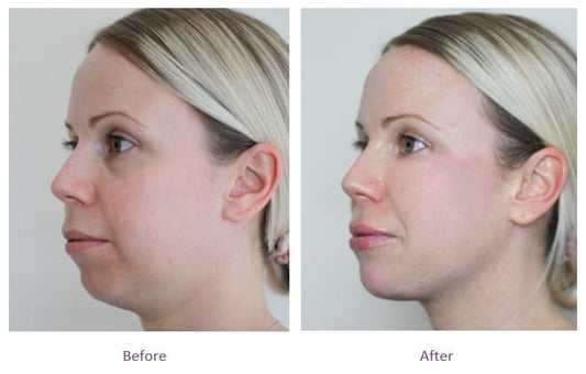 Liquid Facelift  4 Syringes Package (not shipped, clinic use only)