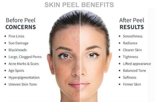 1 Chemical Peel +1  Free Microdermabrasion